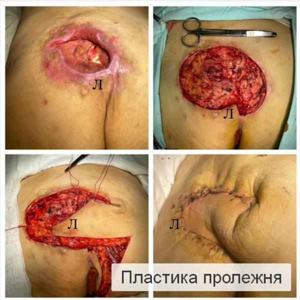 Фото Пластика пролежней