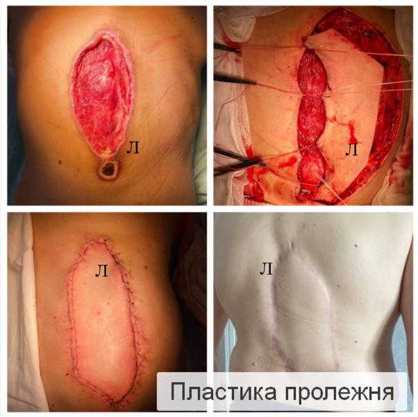 Фото Пластика пролежней