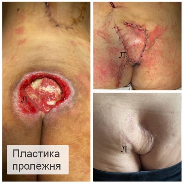 Фото Пластика пролежней