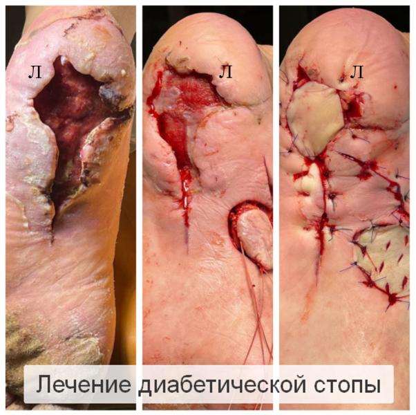 Фото Лечение диабетической стопы