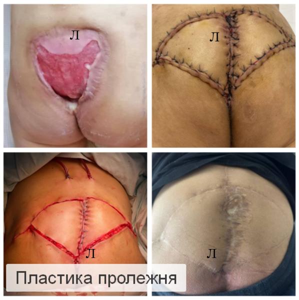 Фото Пластика пролежней
