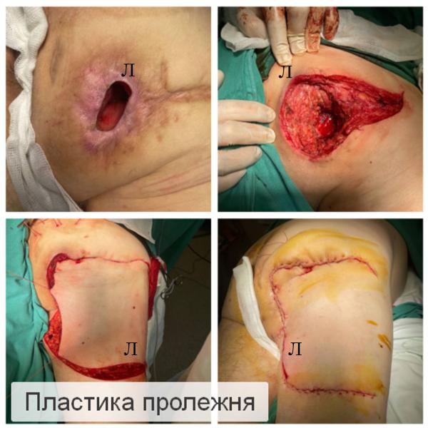 Фото Пластика пролежней