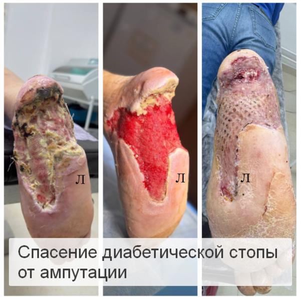 Фото Лечение диабетической стопы