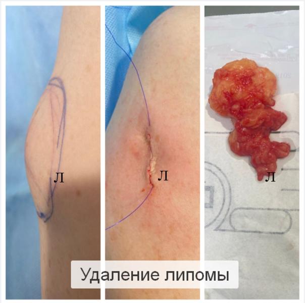 Фото Удаление липомы