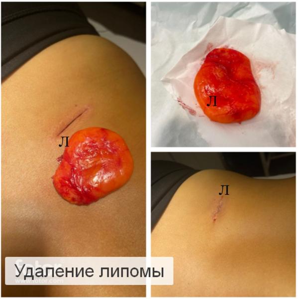 Фото Удаление липомы