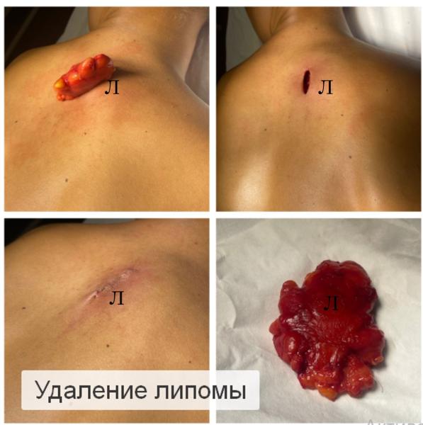 Фото Удаление липомы