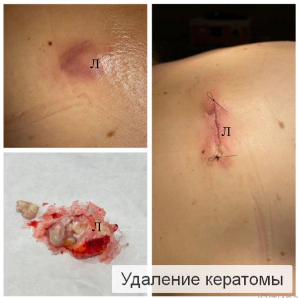 Фото Удаление кератомы