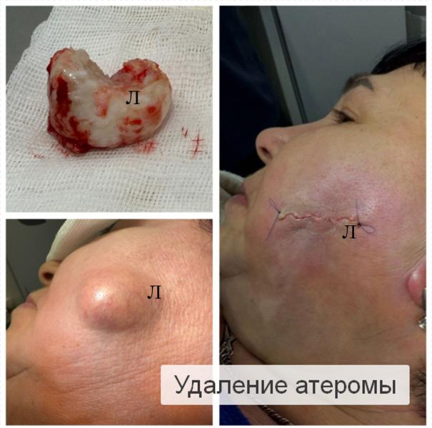 Фото Удаление атеромы