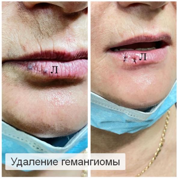 Фото Удаление гемангиомы