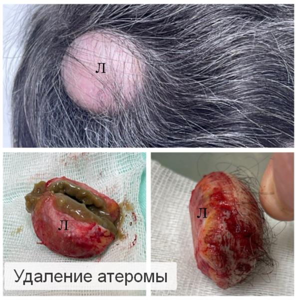 Фото Удаление атеромы