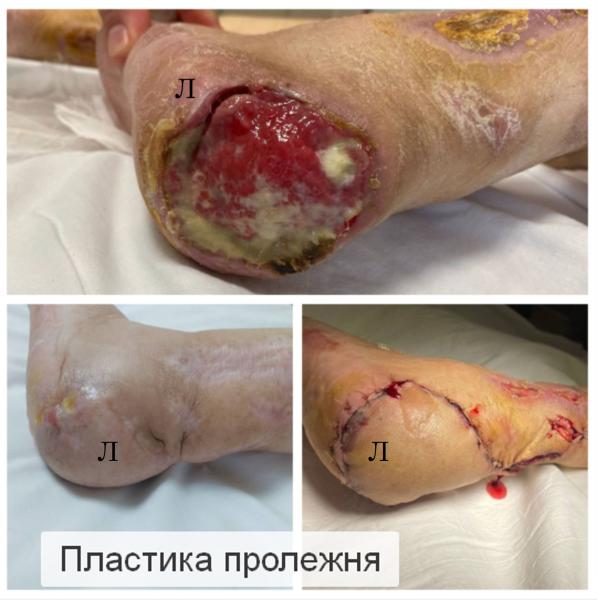 Фото Пластика пролежней